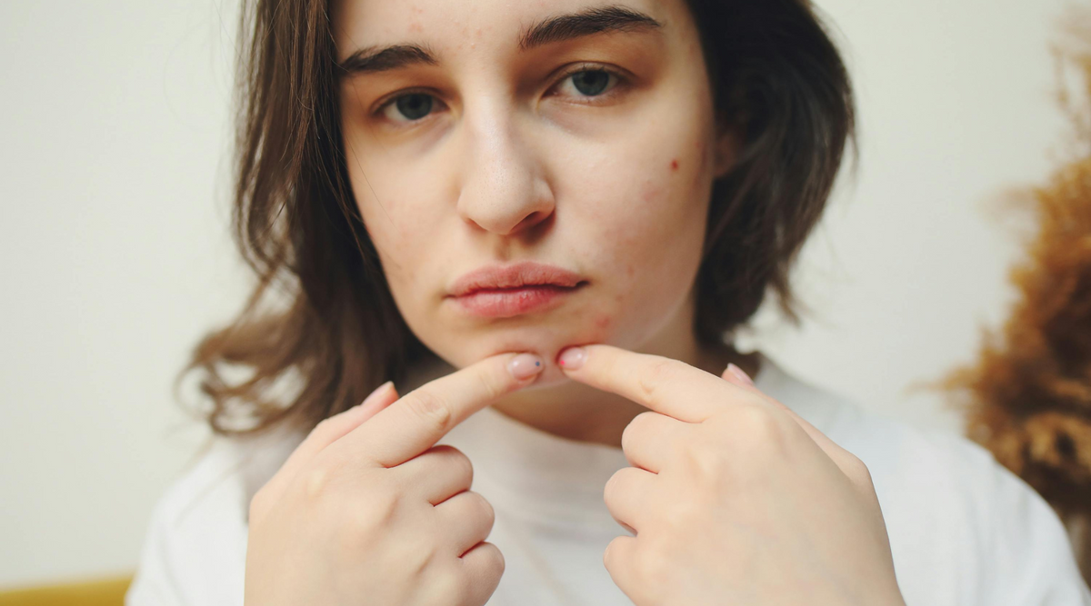 Could Dairy Be Causing Your Acne (and Other Skin Issues)?